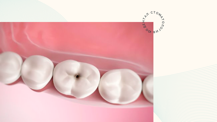 Лечение кариеса